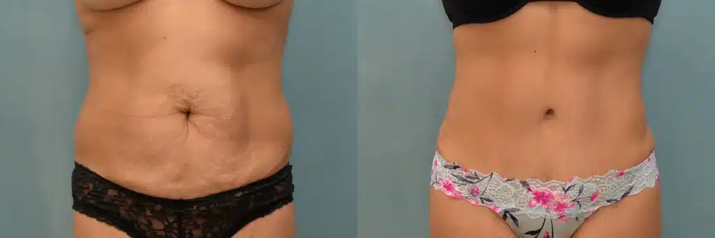 lipo bbl tummy tuck before and after photo by J Gerald Minniti