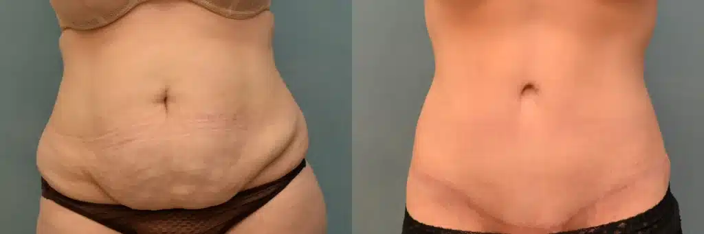 lipo extended tummy tuck before and after photo by J Gerald Minniti