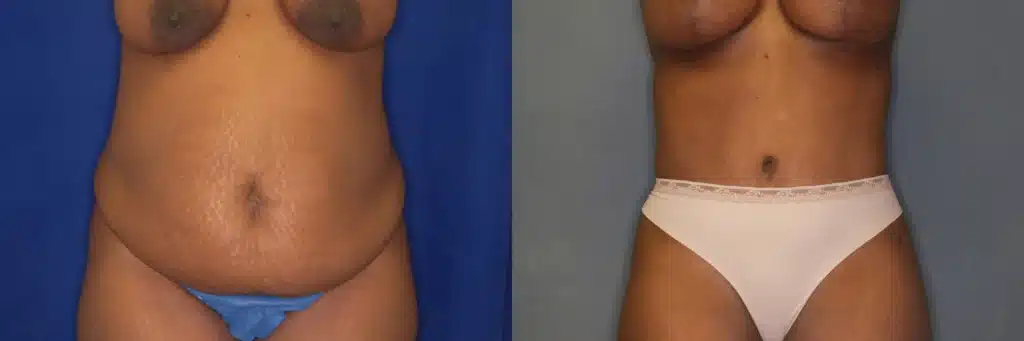 lipo extended tummy tuck before and after photo by J Gerald Minniti
