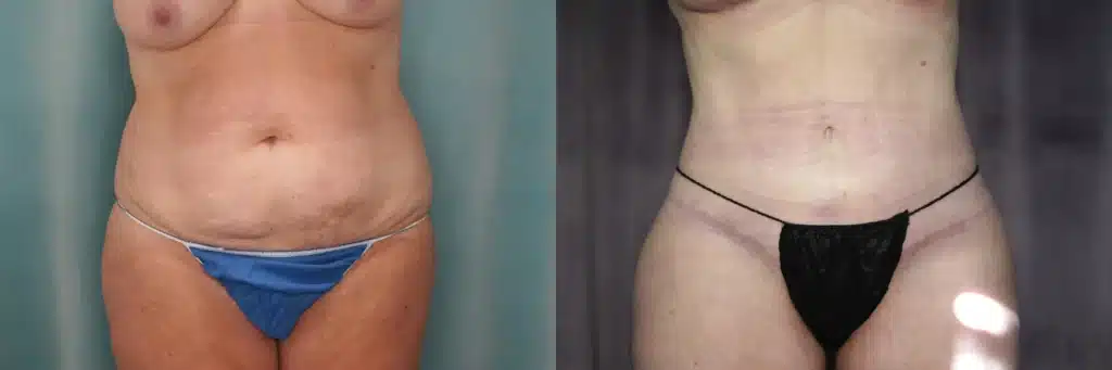 lipo extended tummy tuck before and after photo by J Gerald Minniti