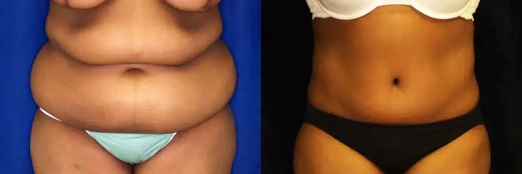 lipo extended tummy tuck before and after photo by J Gerald Minniti