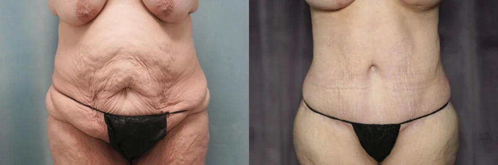 lipo lower body lift before and after photo by J Gerald Minniti