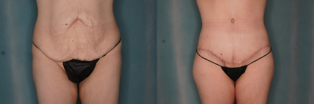 lipo lower body lift before and after photo by J Gerald Minniti