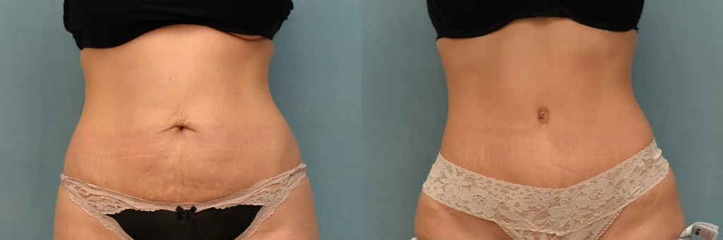 lipo tummy tuck before and after photo by J Gerald Minniti