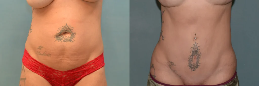 lipo tummy tuck before and after photo by J Gerald Minniti