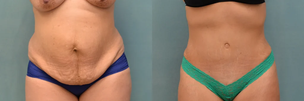 lipo tummy tuck before and after photo by J Gerald Minniti