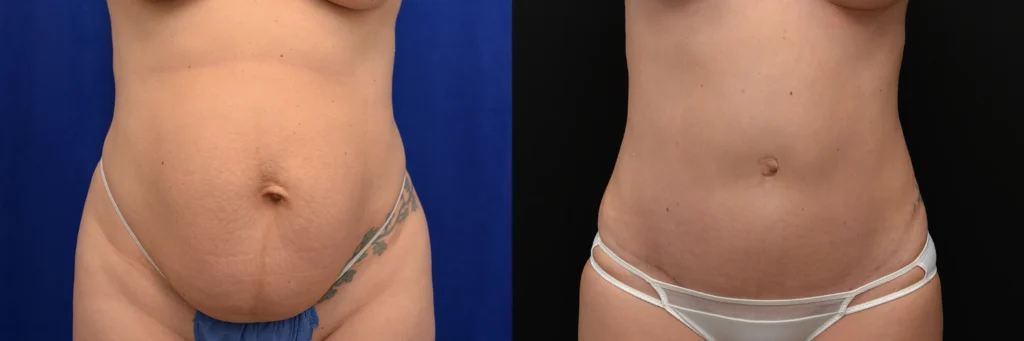 lipo tummy tuck before and after photo by J Gerald Minniti