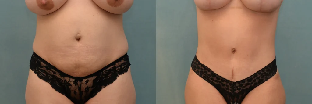 lipo tummy tuck before and after photo by J Gerald Minniti