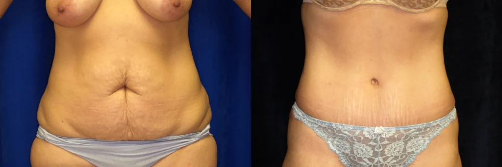lipo tummy tuck before and after photo by J Gerald Minniti