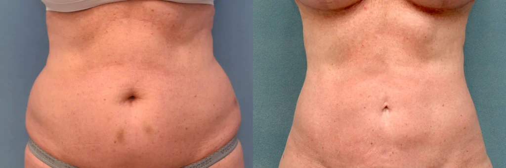 liposuction before and after photo by J Gerald Minniti