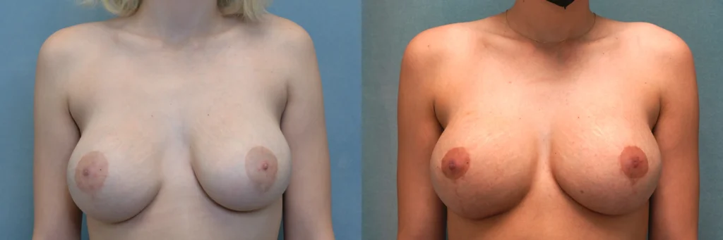 revision aug lift before and after photo by Dr Gerald Minniti