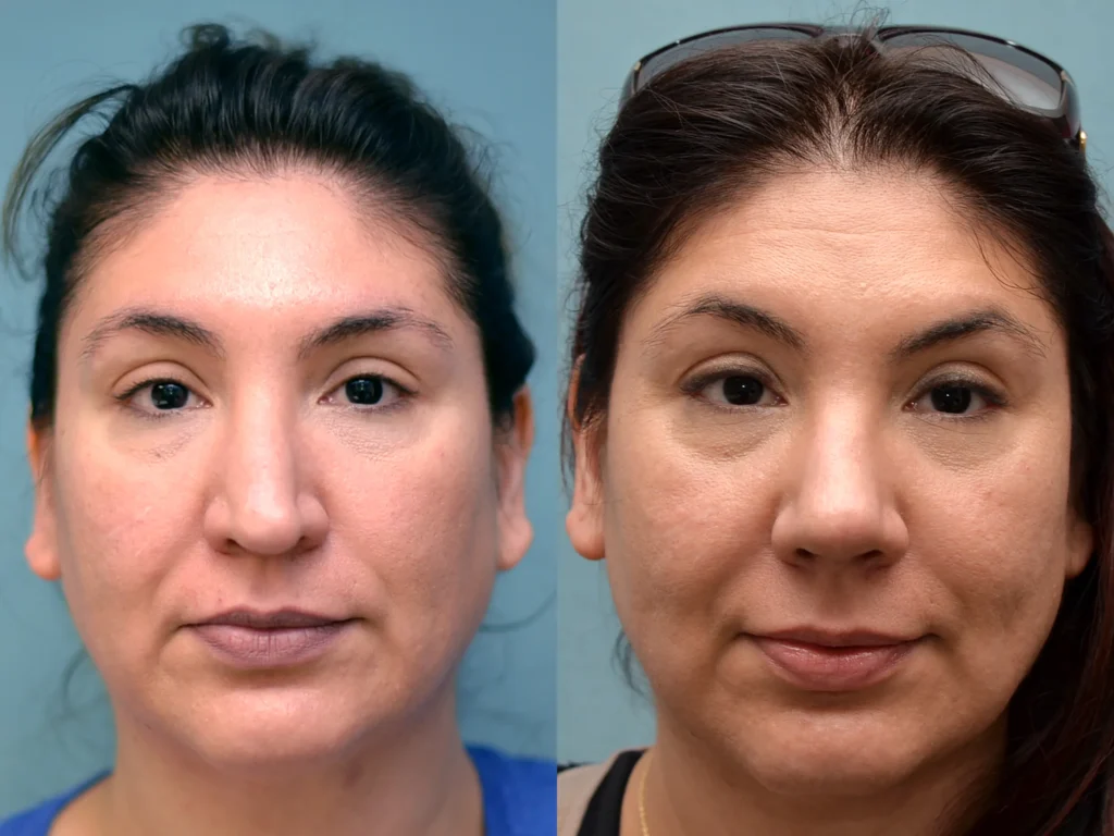 revision rhinoplasty before and after photo by Dr Gerald Minniti