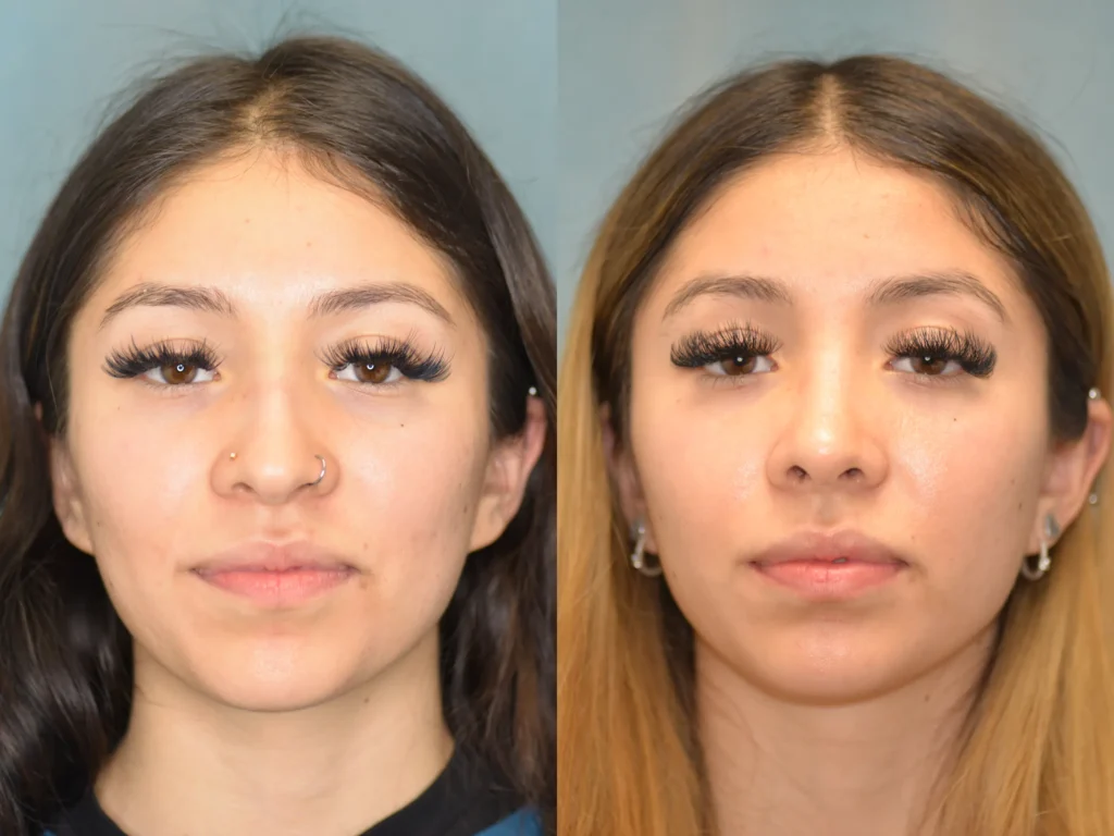 rhinoplasty before and after photo by Dr Gerald Minniti