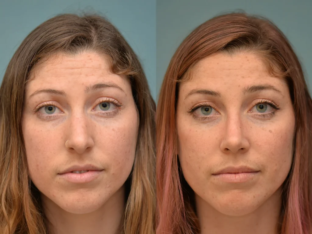 rhinoplasty before and after photo by Dr Gerald Minniti