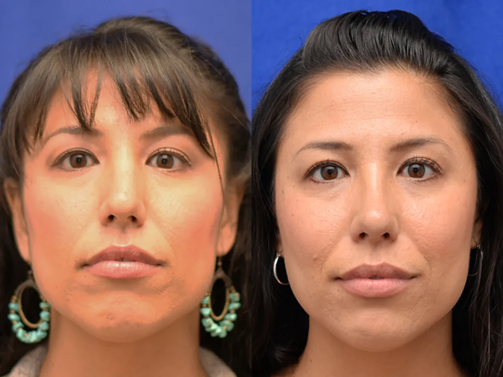 rhinoplasty before and after photo by Dr Gerald Minniti