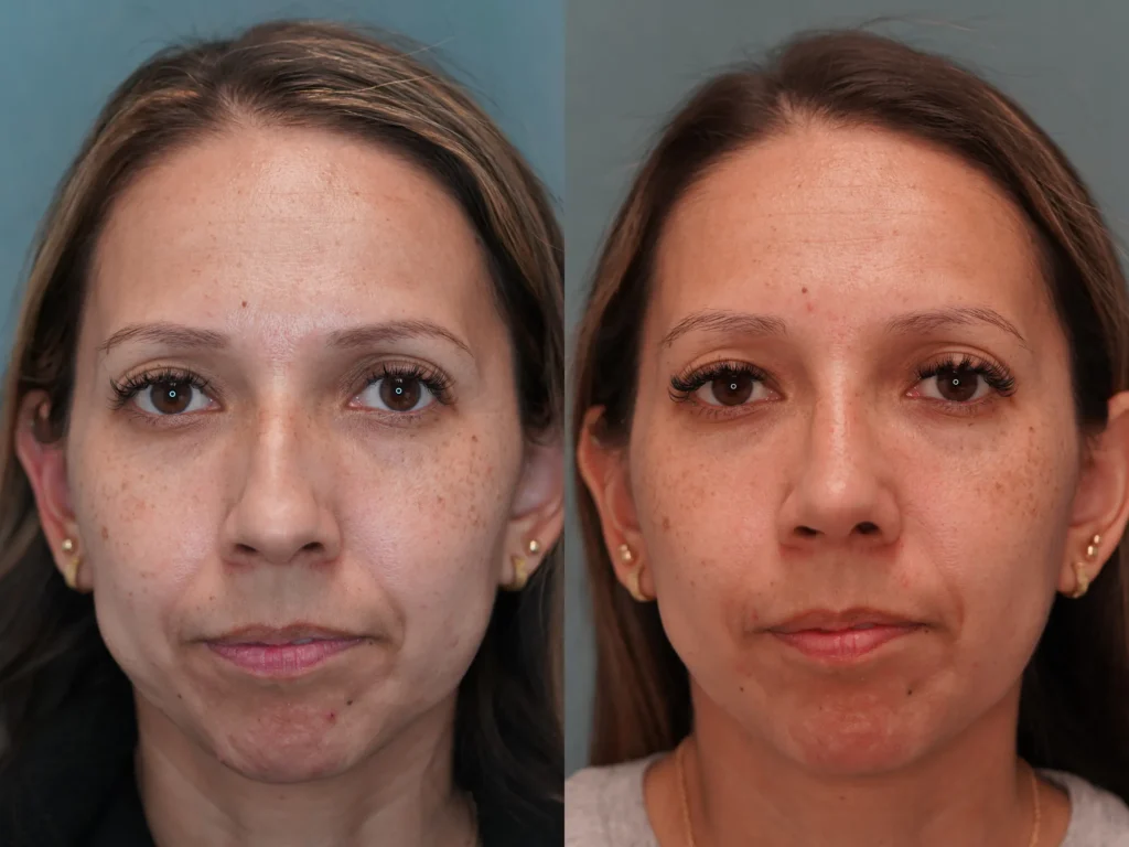 rhinoplasty before and after photo by Dr Gerald Minniti