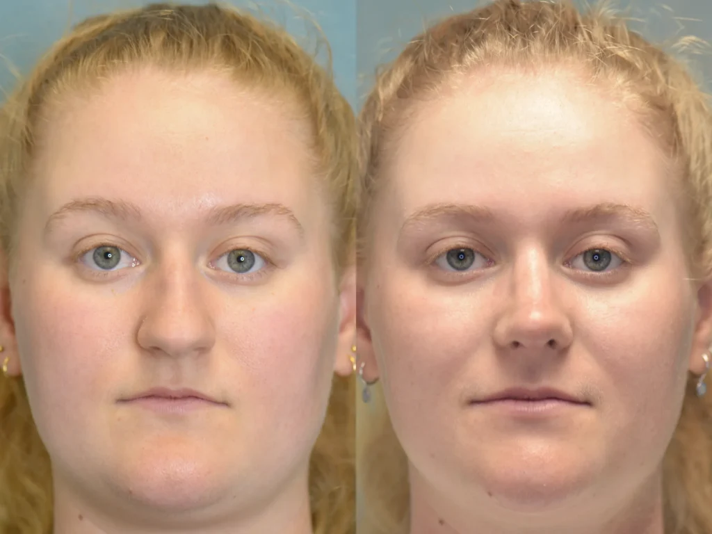 rhinoplasty before and after photo by Dr Gerald Minniti