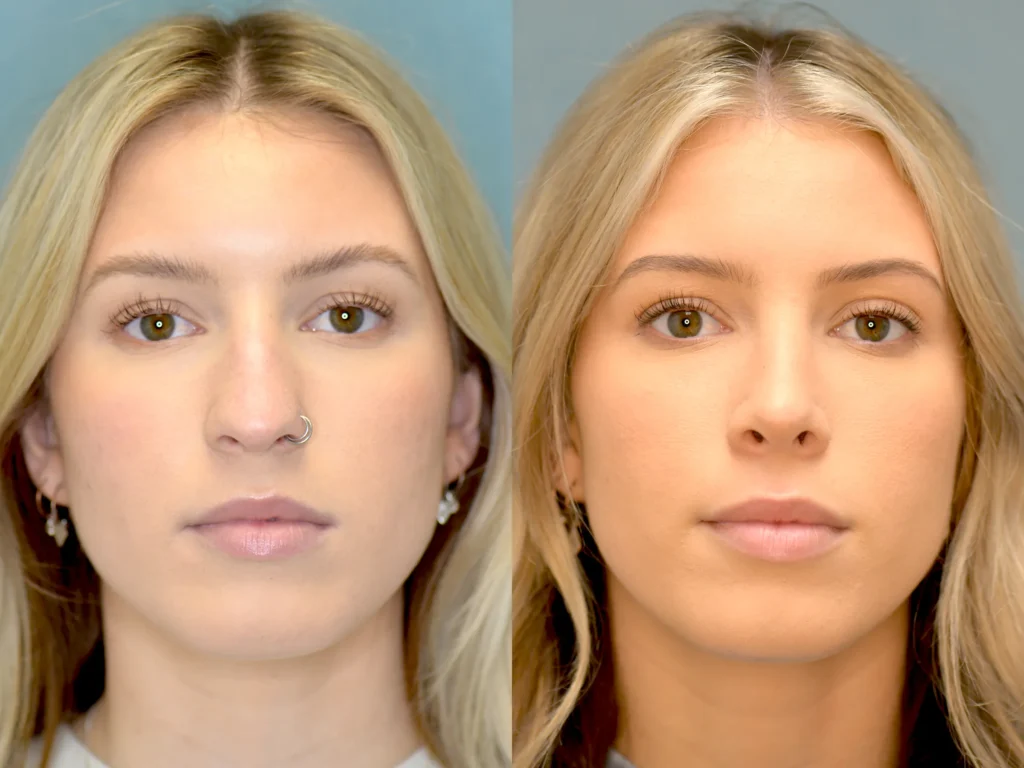 rhinoplasty before and after photo by Dr Gerald Minniti