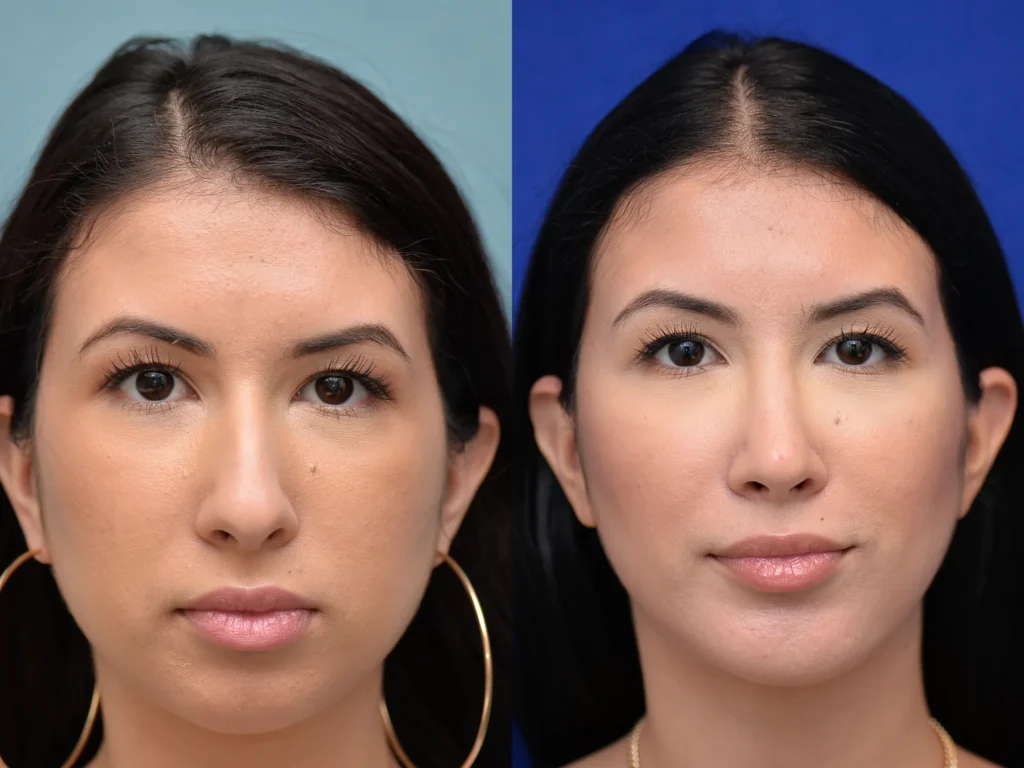 rhinoplasty before and after photo by Dr Gerald Minniti