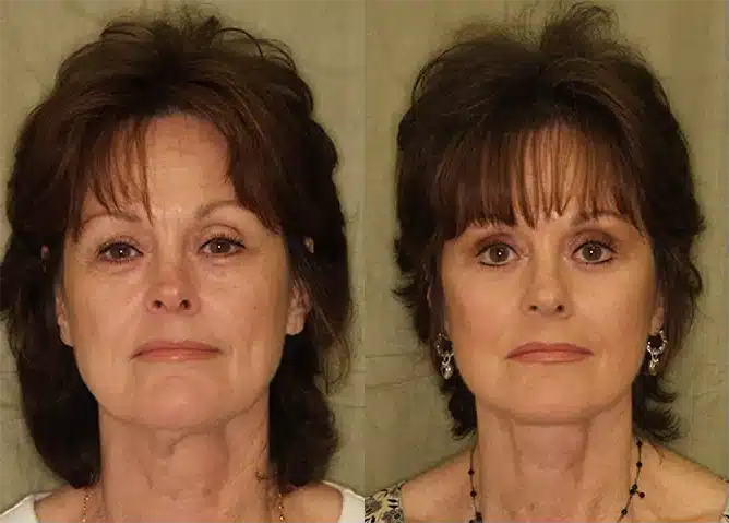 facial rejuvenation before and after photo by j gerald minniti in beverly hills ca