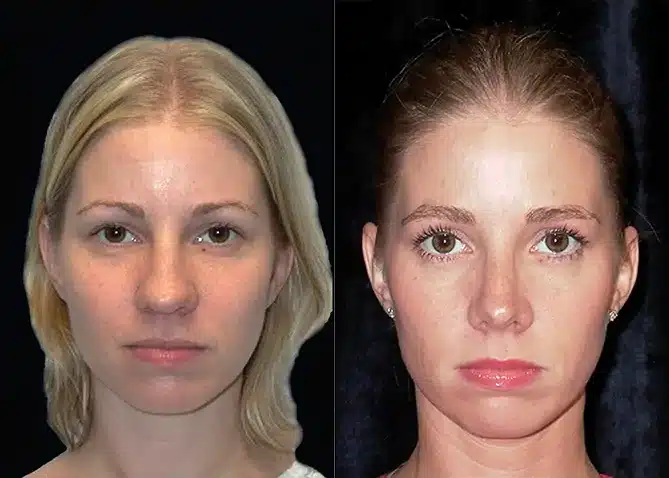 rhinoplasty before and after photo by j gerald minniti in beverly hills ca