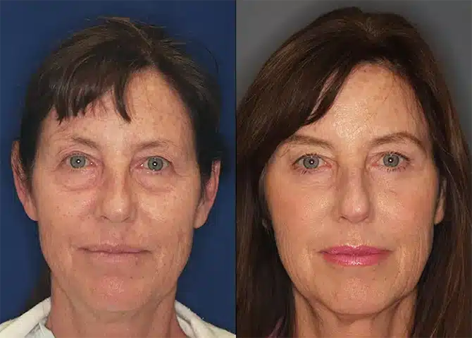 facial rejuvenation before and after photo by j gerald minniti in beverly hills ca