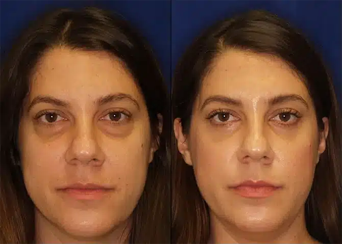 facial rejuvenation before and after photo by j gerald minniti in beverly hills ca