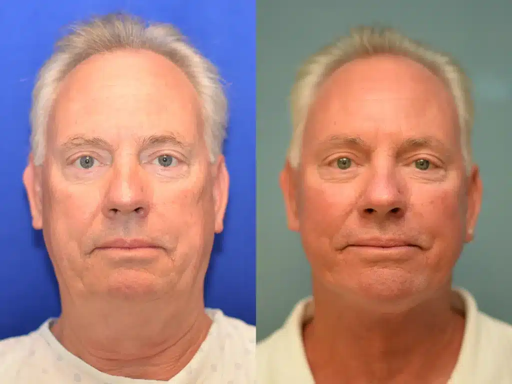 Face and Neck Lift before and after photo by Dr Gerald Minniti x