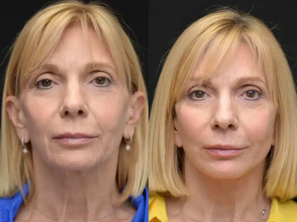 Face and Neck Lift before and after photo by Dr Gerald Minniti x