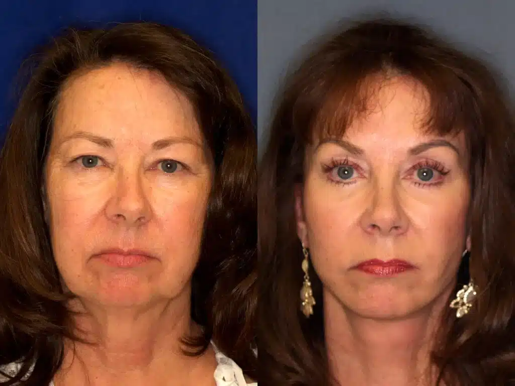 Facelift brow quad bleph before and after photo by Dr Gerald Minniti x
