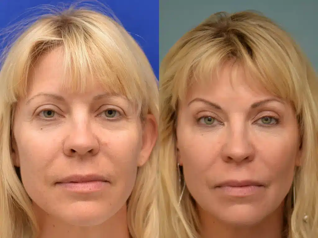 brow lift blepharoplasty before and after photo by Dr Gerald Minniti x