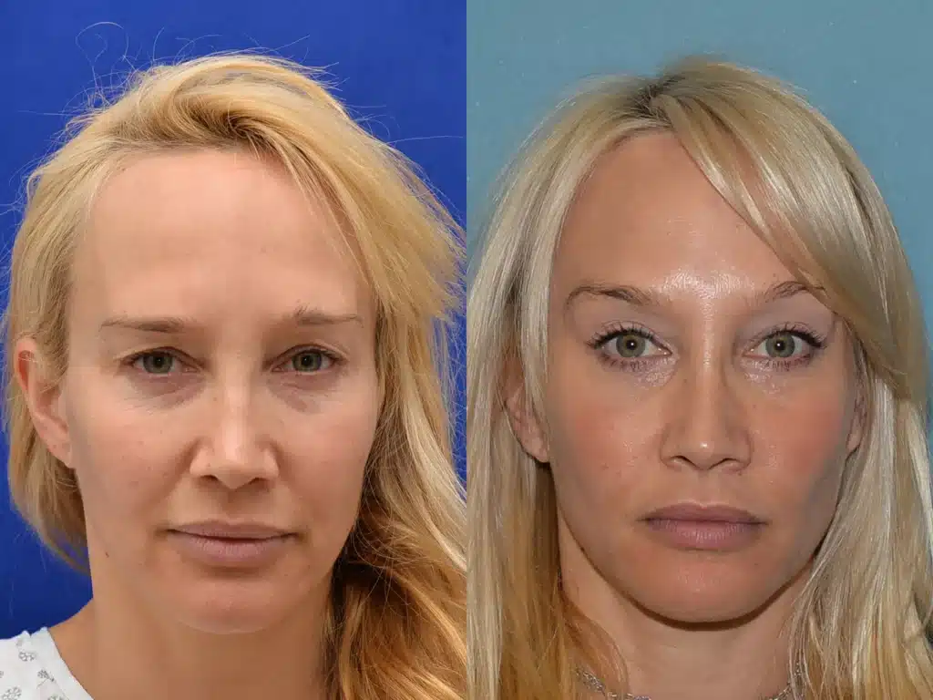 brow lift blepharoplasty before and after photo by Dr Gerald Minniti x