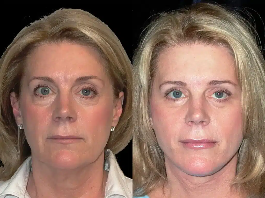 facelift necklift browlift quad bleph before and after photo by Dr Gerald Minniti x ()
