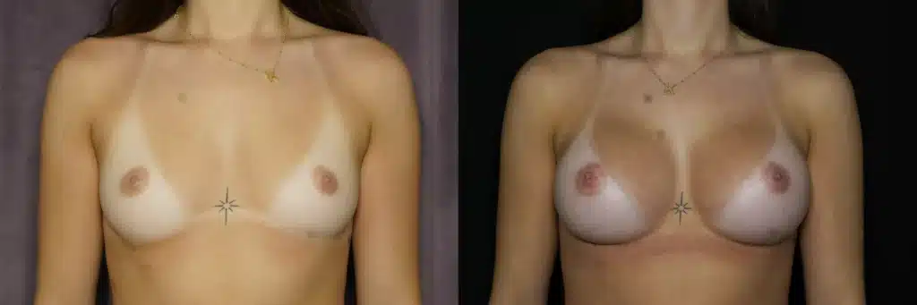 front view breast augmentation before and after photo by Dr Minniti