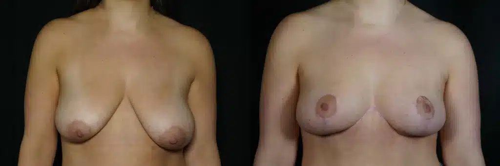 front view breast reduction before and after photo by Dr Minniti ptHB