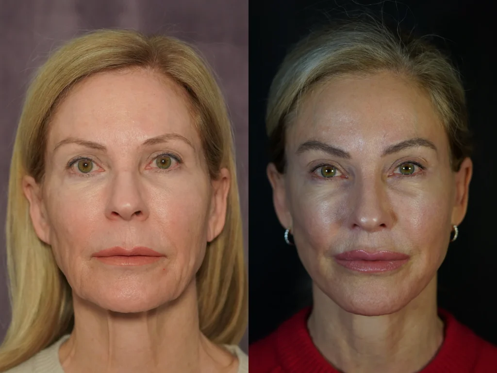front view facelift, necklift, browlift, quad bleph, lip lift, laser before and after photo by Dr Gerald Minniti
