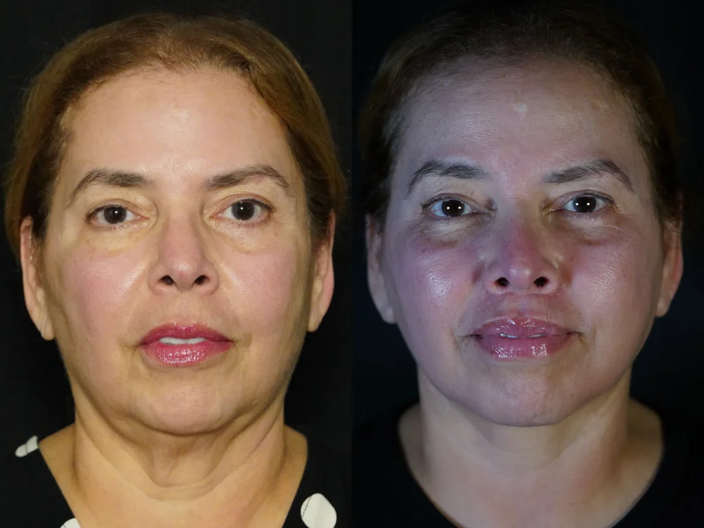 front view facelift, necklift, browlift, upper bleph, lip lift before and after photo by Dr Gerald Minniti