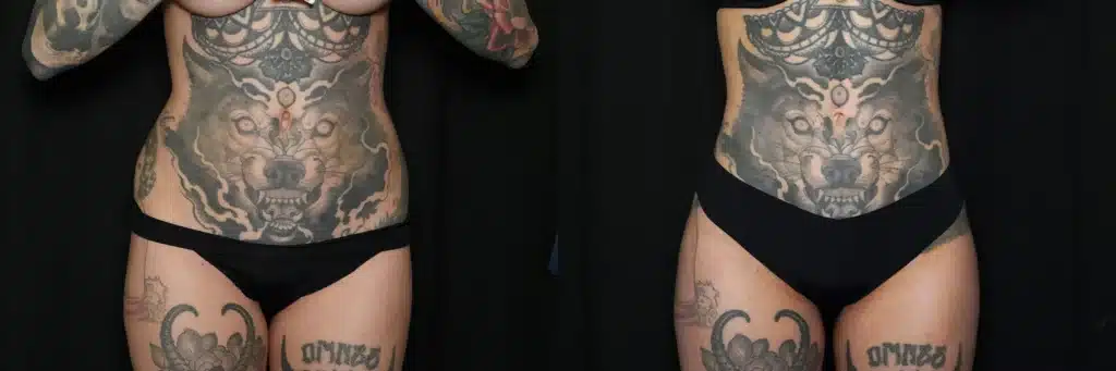 front view lipo fat grafting buttocks before and after photo by Dr Minniti