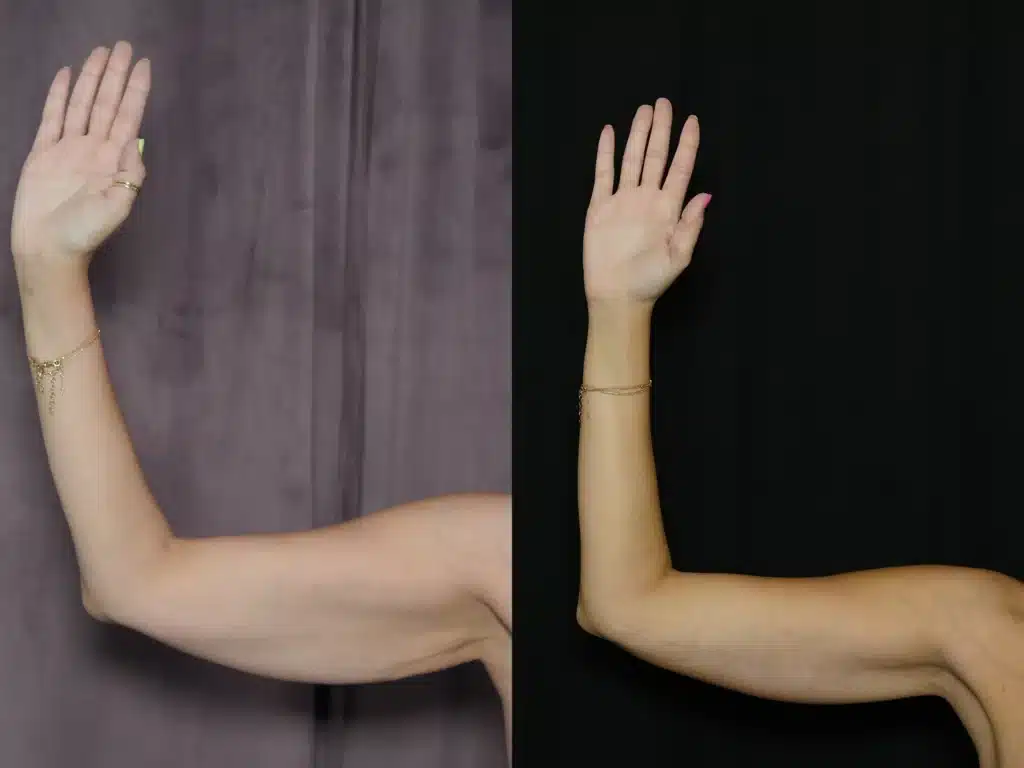 right front view arm lift before and after photo by Dr Minniti