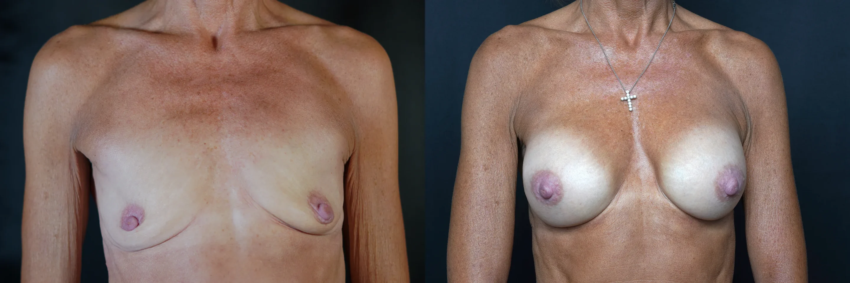 Front View Preserve Breast Augmentation before and after photo by Dr Gerald Minniti CC
