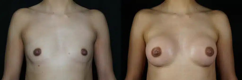 Front View Preserve Breast Augmentation before and after photo by Dr Gerald Minniti KE