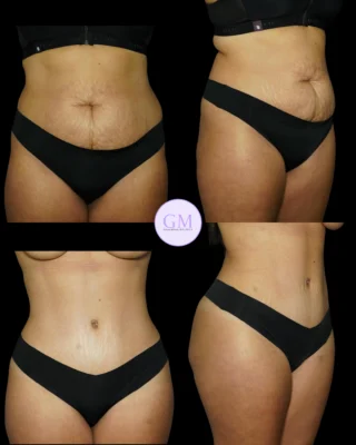 semaglutide vs. tirzepatide which glp-1 is right for you Semaglutide vs. Tirzepatide for Weight Loss